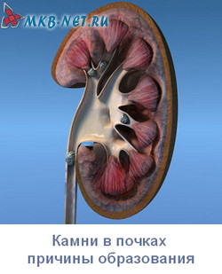 Камни в почках причины